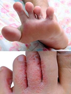 The foot is a mushroom