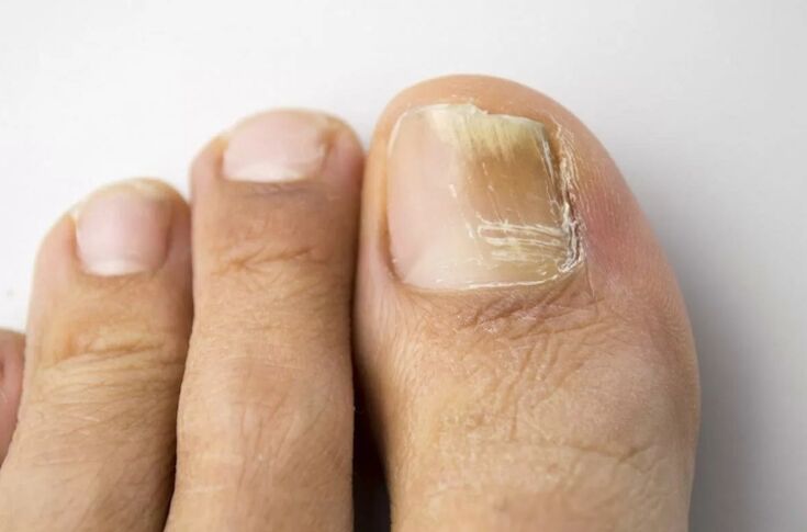 The angle on the foot is mycosis