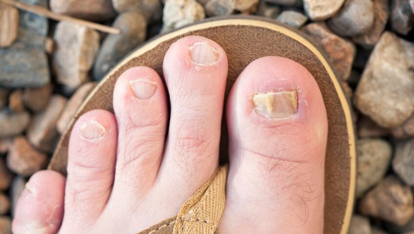 The nails onikchomycosis